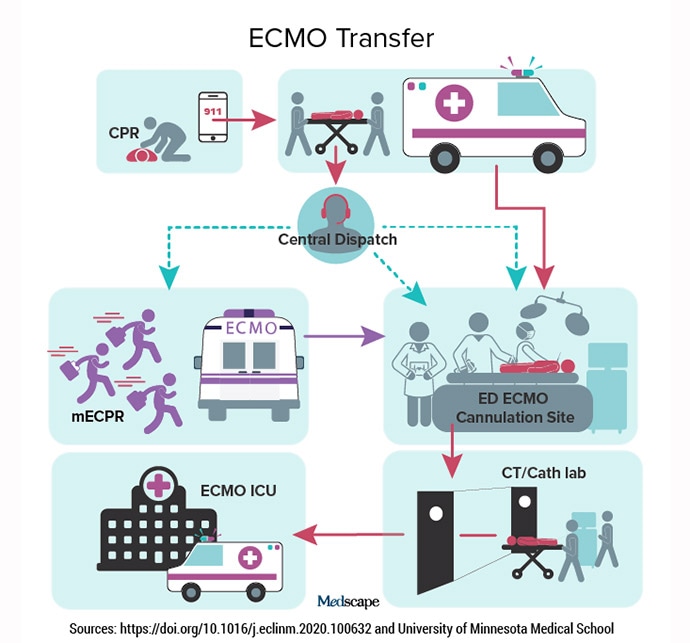 photo of ECMO transfer