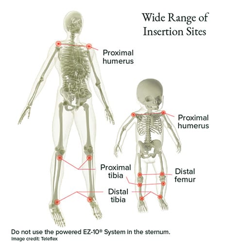 Intraosseous Access Simplified: Tips for Saving Lives