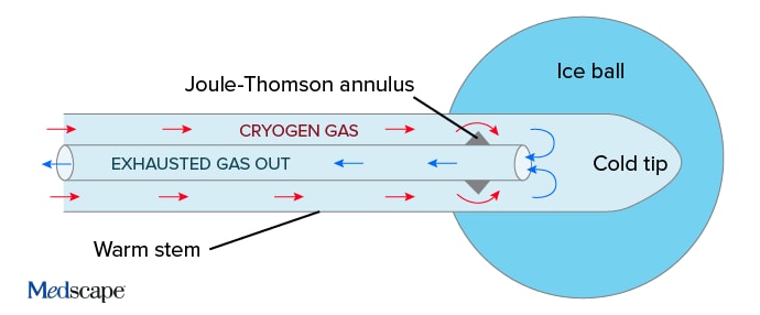 photo of Cryoneurolysis probe 