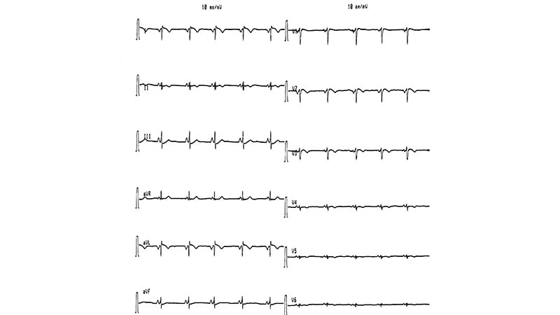 ECG : malaises intermittents chez une femme de 24 ans