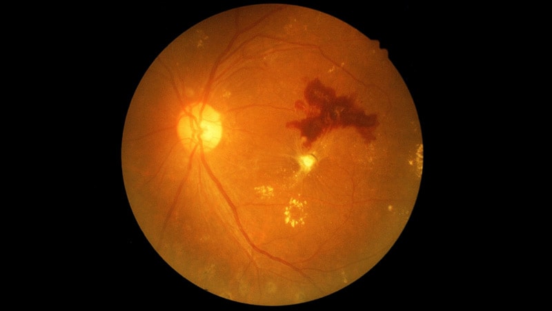 Anti-VEGF a Safe Swap for Laser in Diabetic Retinopathy