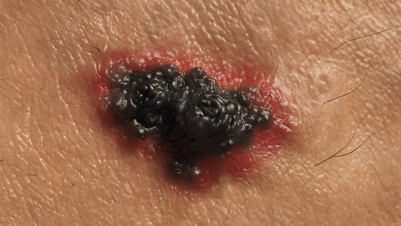 Potential for Long-Term Survival With ICIs in Melanoma