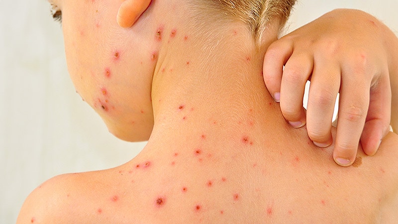 Lab Tests Are Key for Diagnosing Chickenpox