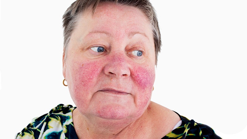 Erenumab Reduces Flushing and Erythema in Rosacea