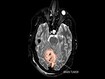 photo of Medulloblastoma brain scan