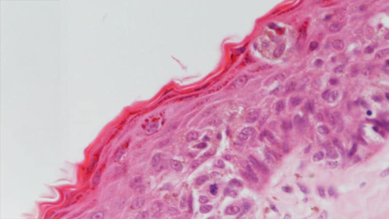 Calculator Aids With Assessing SNL Metastasis Risk in Melanoma