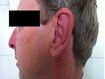 photo of Relapsing polychondritis