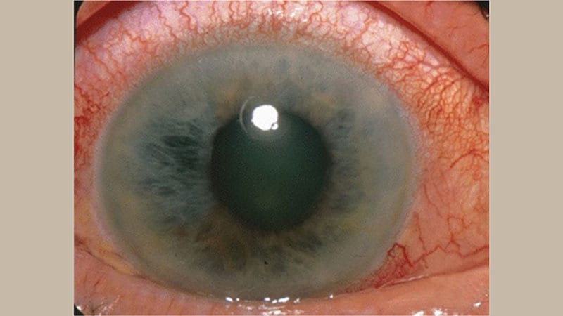 Blind Spots: Comparing the Vision Costs of Weight-Loss Drugs