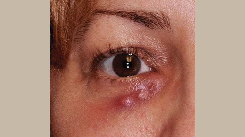Age Ups Risk for Acute Dacryocystitis in Blocked Tear Ducts