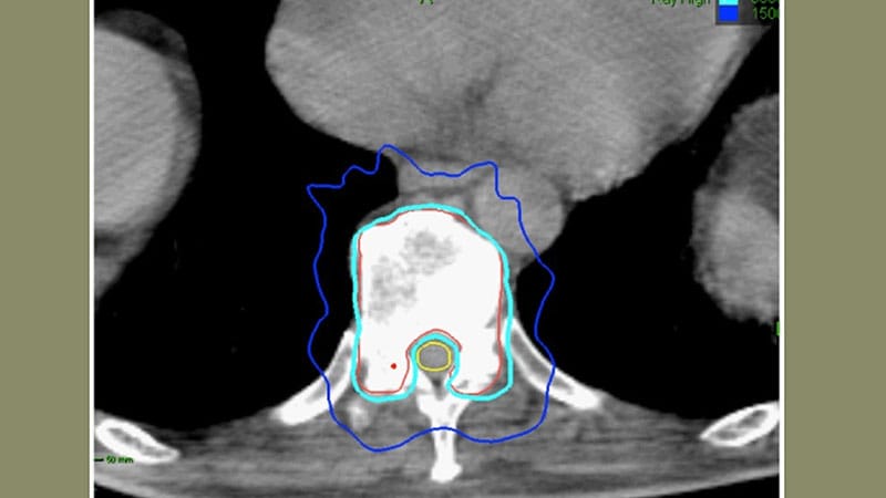 SBRT Extends ADT-Free Survival in Advanced Prostate Cancer