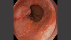 Barrett Esophagus Onset Occurs Decades Before Diagnosis