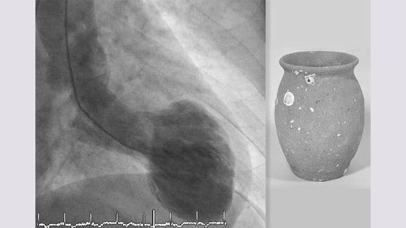 Takotsubo Cardiomyopathy Triggers Rare Coronary Embolism