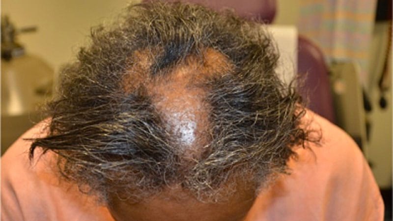 Research Uncovers Mental Health Toll of Alopecia on Women