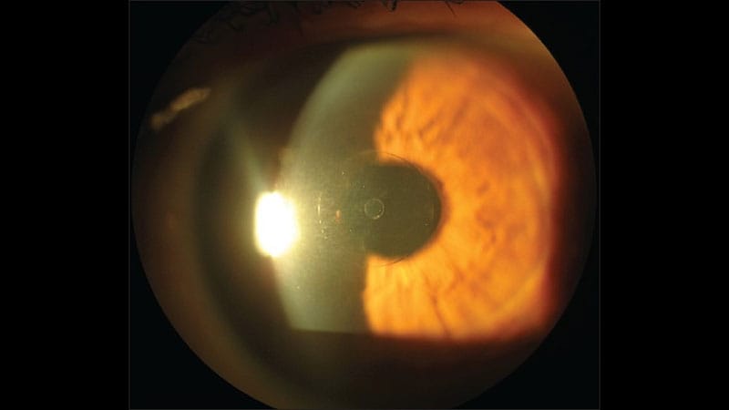 Adrenergic Antagonist Improves Near Vision in Presbyopia: VEGA-3 Trial Findings