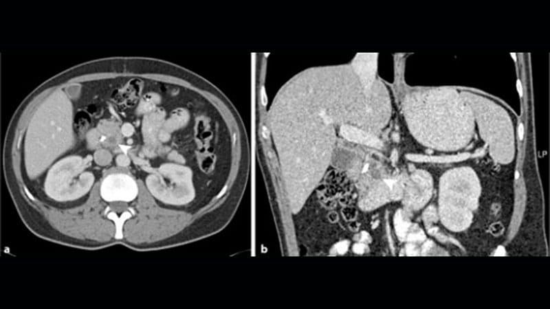 Pancreatic Cancer Specialists Getting a Jump on Daraxonrasib - medscape.com