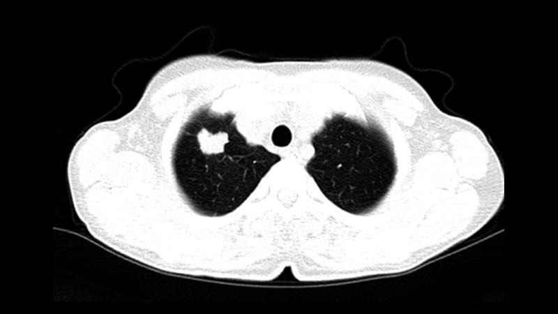 Missed Opportunities for Early Lung Cancer Detection