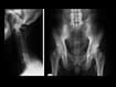 photo of x-ray image of axial spondyloarthritis