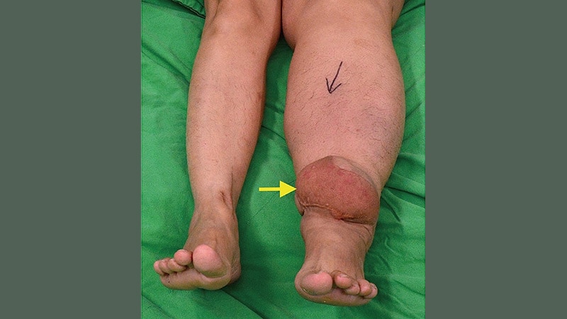 The Weight of Two Worlds: Lipo-Lymphedema and Obesity