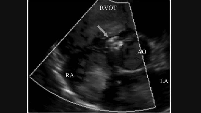 Anticipating Tricuspid Valve Regurgitation