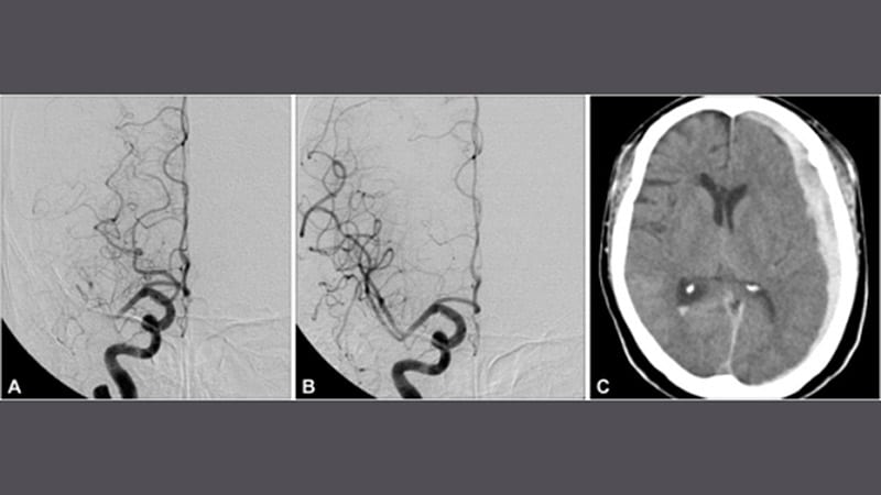 Tenecteplase Effective for Stroke in Later Time Window
