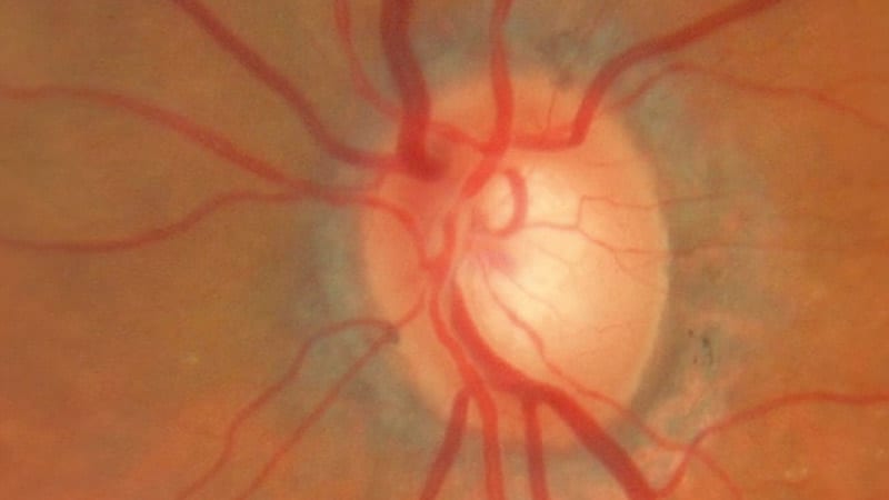 Open-Angle Glaucoma Dx: Polygenic Risk Score Found Useful