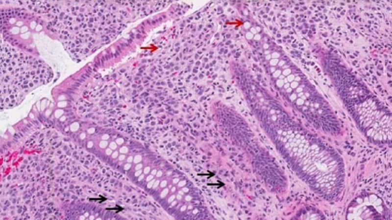 CDH1 lié au nouveau syndrome du cancer du sein héréditaire