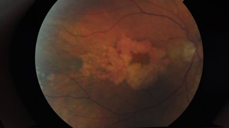 Lampalizumab Keeps Intraocular Pressure Steady