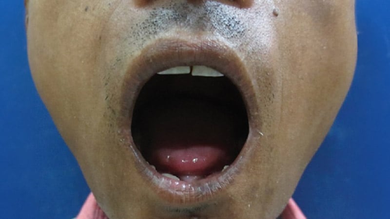 Managing Orofacial Changes in Scleroderma thumbnail