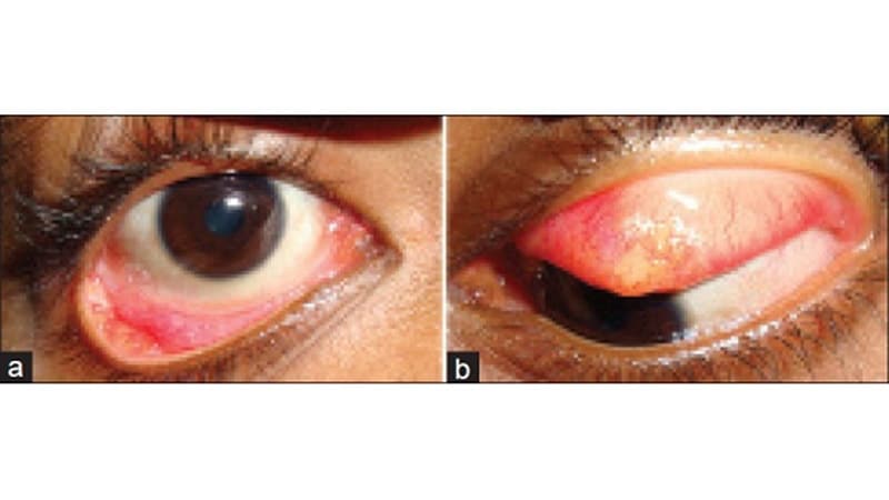 Eyelid Imaging Could Aid Early Diagnosis of Sjögren Disease