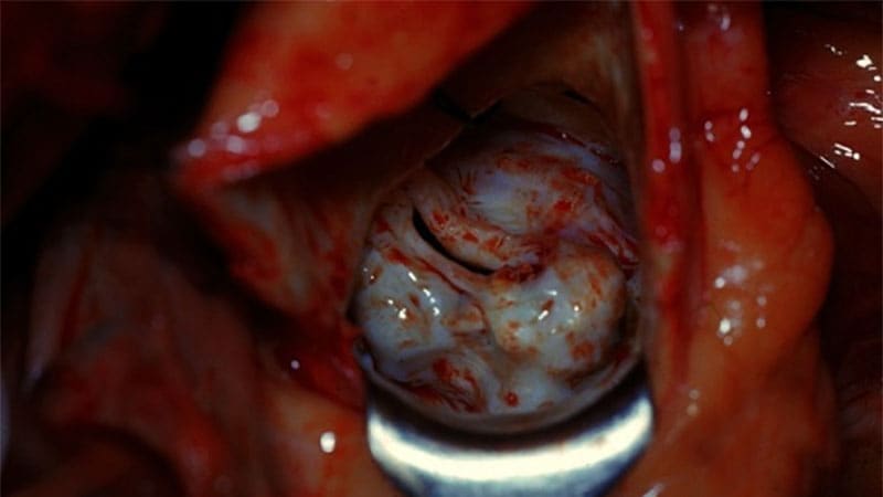 TAVR Beats Surveillance for Asymptomatic Aortic Stenosis