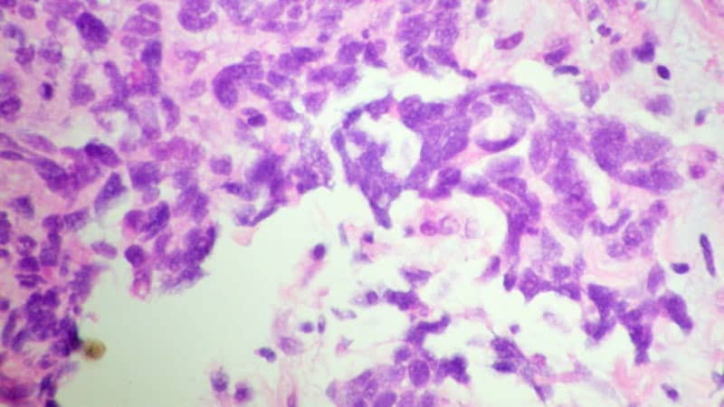 Trial Analysis Characterizes SCLC Disease Progression
