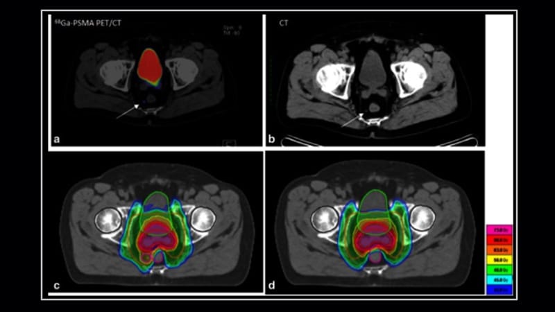 PSMA PET: Prostate Cancer Staging Revolution Awaits RCT Data