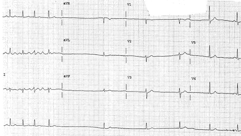ECG Challenge: On-Again, Off-Again Lightheadedness