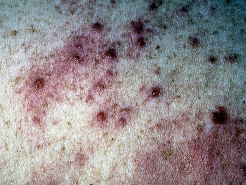 photo of Grover disease