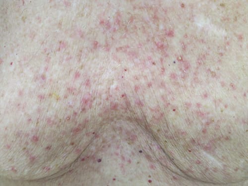 photo of Grover disease in a patient.