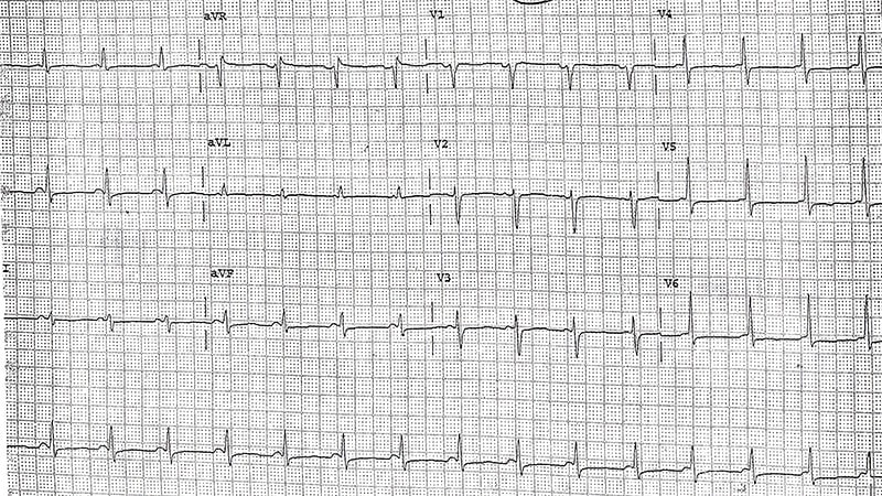 ECG : pression artérielle incontrôlée lors d'un examen de routine