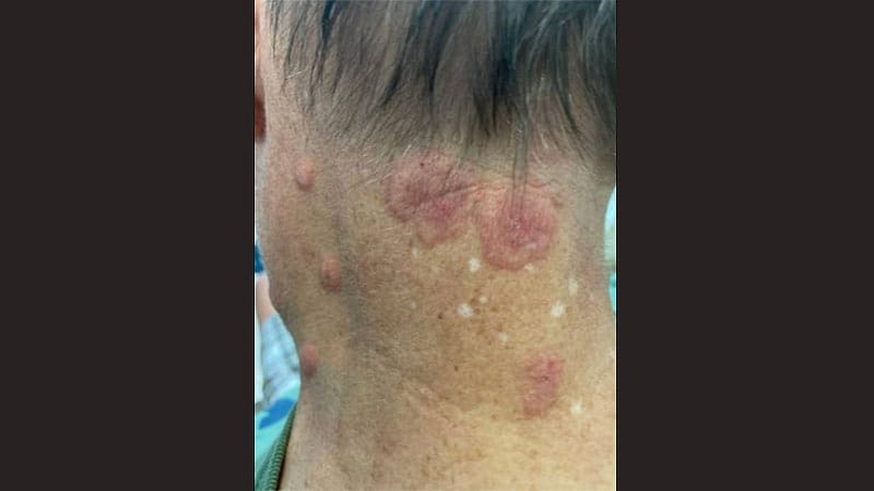 Persistent Painful Rash in a 63-Year-Old Man