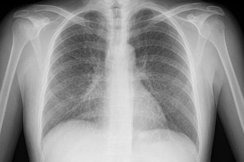 A Nonsmoker With a Persistent Stubborn Cough