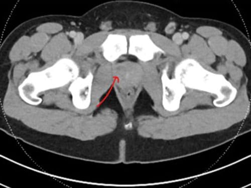 Persistent Dysuria in a 30-Year-Old Man With Crohn’s Disease