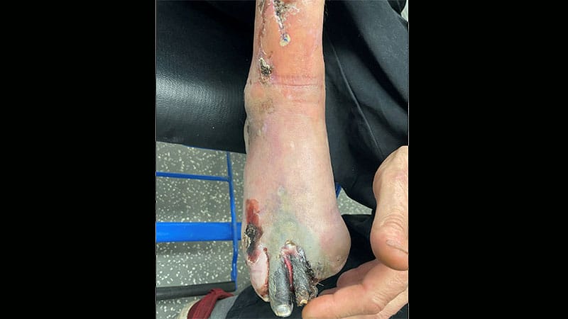 Violaceous Retiform Rash With Ischemia in a 66-Year-Old Man