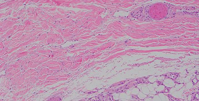 Violaceous Retiform Rash With Ischemia in a 66-Year-Old Man