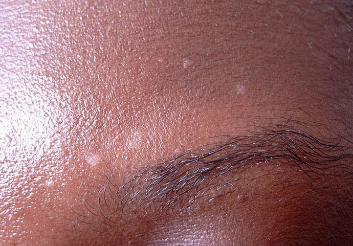 A 27-Year-Old Model With White Facial Macules and Graying Hair