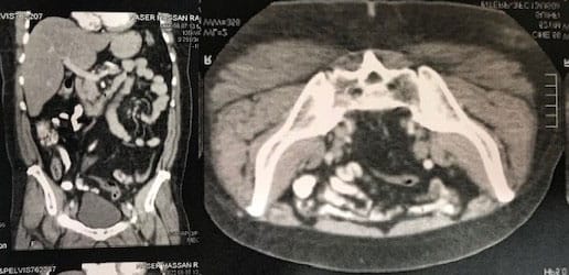 Abdominal Pain in a 29-Year-Old Physician