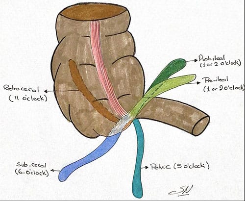 Abdominal Pain in a 29-Year-Old Physician
