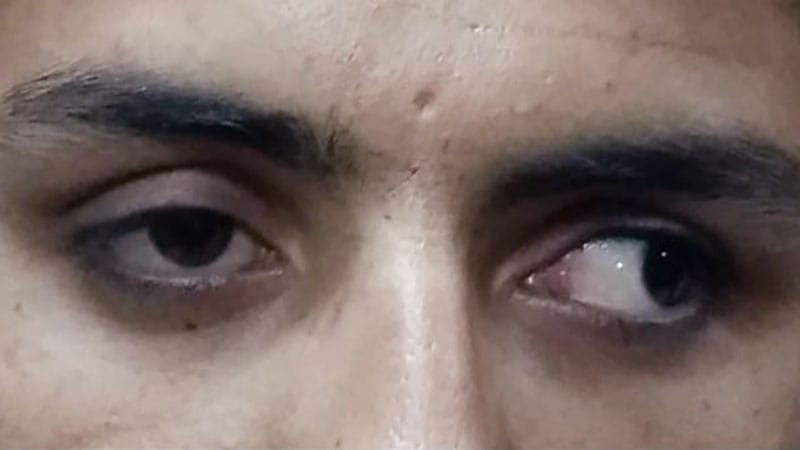 Desafio Diagnóstico: Pedreiro de 25 anos com diplopia indolor e sintomas inexplicados