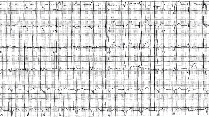 ECG Challenge: Out of Sync After ICD Surgery