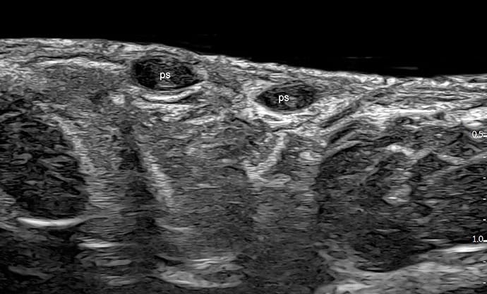 photo of Pseudocysts (labeled ps): Round or oval-shaped hypoechoic or anechoic dermal and/or hypodermal sac-like structures