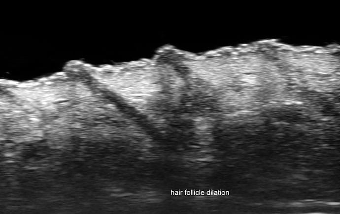 photo of Hair follicle dilation and epidermal thickening.