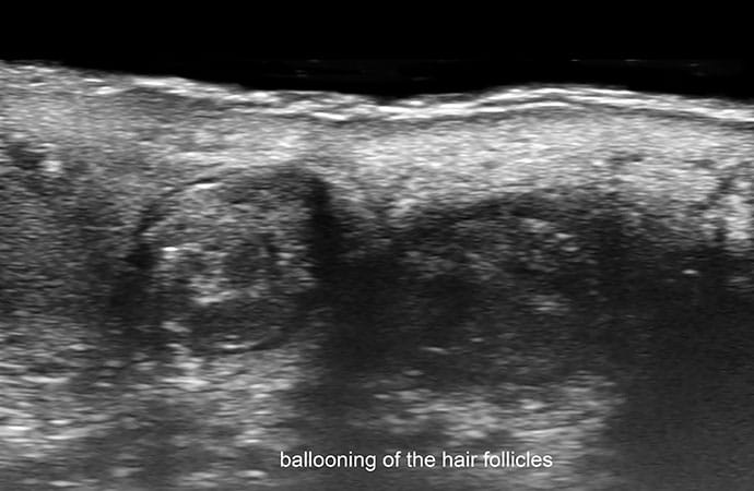 photo of Ballooning of the hair follicles.