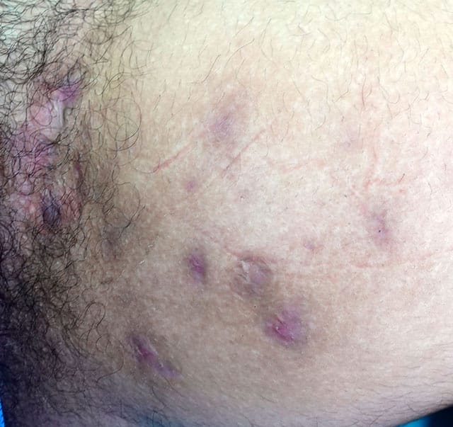 photo of hidradenitis suppurativa lesion affecting the left groin region.